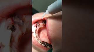 Laser gingivectomy area 23 tooth [upl. by Sirrep]