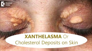 FATTY DEPOSITS of CHOLESTEROL around EYES  How to get rid of itDrRajdeep MysoreDoctors Circle [upl. by Aneliram488]