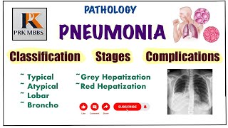 Pneumonia Pathology  Stages Of Pneumonia  Complications amp Lung Abscess pathology robbins [upl. by Amargo]