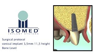 ISOMED  Surgical protocol  Bone Level Implant [upl. by Ruben]