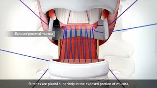 Cricotracheal resection for subglottic tracheal stenosis [upl. by Netfa]