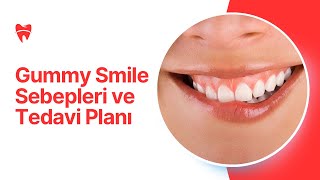 Gummy Smile Sebepleri ve Tedavi Planı [upl. by Anelet]