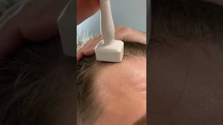 Derma Stamping And Using Minoxidil For Hair Growth [upl. by Eatnoed]