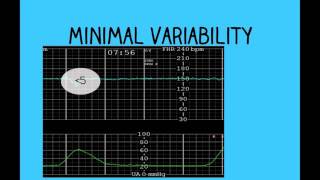 Topic 26 Intrapartum Fetal Surveillance [upl. by Bird]