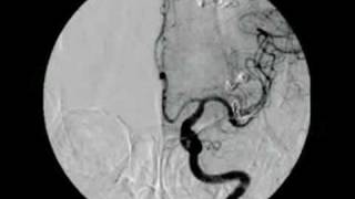 BRAIN ANEURYSM  ANEURISMA CEREBRAL 2 [upl. by Nilad877]