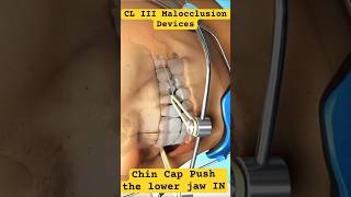 CL III Malocclusion Orthodontics Devices [upl. by Sitoiyanap]