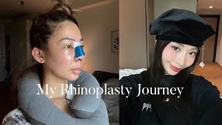 MY RHINOPLASTY JOURNEY 👃🏼✨ [upl. by Cleave460]