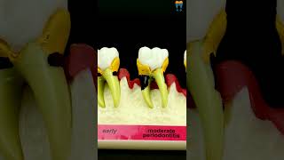 iDENTical Stages of Periodontitis Model  M4010  Patient Education Tool shorts dental viralvideo [upl. by Yenetruoc]