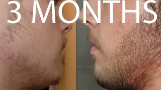 Minoxidil Beard 3 months INCREDIBLE results timelapse [upl. by Agace515]