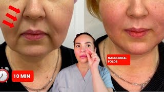 EFFECTIVE TECHNIQUES FOR THE NASOLABIAL FOLDS  NO WORDS [upl. by Gnanmos]