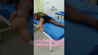 PCL Surgery after rehab tranding physiotherapy exercise physio mbbs shortvideo trending [upl. by Dong]