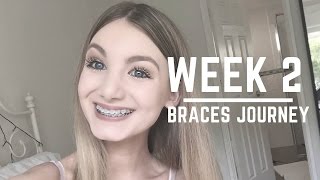 Progress Update amp Advice On Getting Food Out Of Your Braces  WEEK 2 [upl. by Nylegna710]