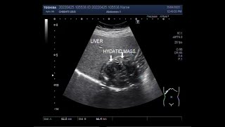 Hepatic Hydatid Cyst [upl. by Nawram]