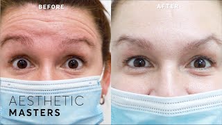 Botox Treatment  Forehead Anti Ageing Injections Before and Afters [upl. by Cassius]