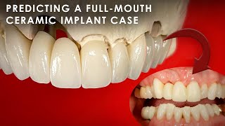 How to predict a FullMouth Ceramic Implant Case [upl. by Ivad]