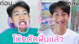 โบ๊ทดัดฟัน ครั้งแรกในชีวิต EP1 ใส่เหล็กแล้วว [upl. by Enomas]