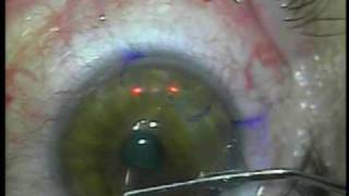 Lasik Cirugia Refractiva VISION SANA Colombia [upl. by Edmond]