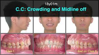 Treatment of Skeletal Class II Malocclusion with Invisalign｜【Chris Chang Ortho】CC798 [upl. by Haibot]