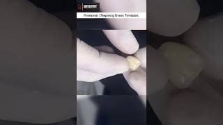 Temporary Crown Formation with Teeth Coloured Acrylic  Temporization Process shorts dentist yt [upl. by Ario]