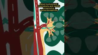 MRCP Exam tip CGPA vs EGPAGranulomatosis with polyangiitis [upl. by Bobby450]