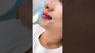 Lip Fillers Technique by Dr Muskan Tyagi  Dermalyn Aesthetics  APPOINTMENT CALL 9999189391 [upl. by Vories]