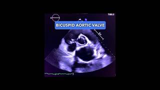 What does a Bicuspid Aortic Valve look like echocardiography cardiology echocardiogram [upl. by Ayet837]