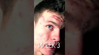 Get rid of your acne with my program TheAcneMethodcom What happened on worlds highest dose acne [upl. by Sonitnatsnok259]