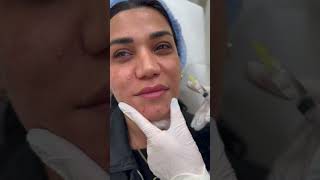 Exosome ilə gözəlliyə doğru 🥰💋 renasoltanova fullface botox renapace kosmetoloq rena [upl. by Nagar]