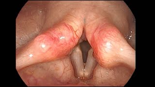 Reflux Laryngitis and Arytenoid Mucosa Vascularity [upl. by Moitoso471]