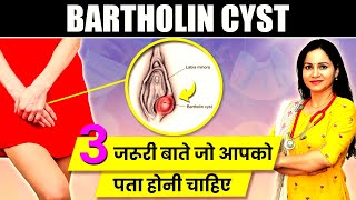 Bartholin Cyst Ayurvedic Treatment  3 Common Myths About Bartholin Cyst  Dr Kanchan Sharma [upl. by Davena673]