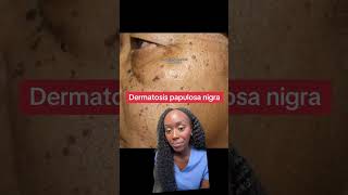 Why Do I Have These Dark Skin Spots Understanding Dermatosis Papulosa Nigra [upl. by Uahc290]