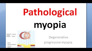 Ophthalmology Pathological myopia crescent Foster Fuchs spot lattice posterior staphyloma atropine [upl. by Aihsoek]