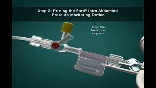 IntraAbdominal Pressure Monitoring [upl. by Northey]