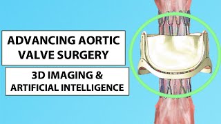 Patient Webinar Advances in Aortic Valve Surgery with 3D Imaging amp Artificial Intelligence [upl. by Boote]