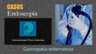 Gastropatía eritematosa [upl. by Attenaej740]