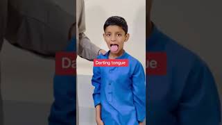 Rheumatic chorea  sydenham chorea  st Vitus dance  dr ishaq buner [upl. by Ecnarf]