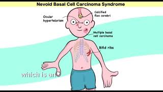 Gorlin syndrome nevoid basal cell carcinoma syndrome  Mnemonic  easy learning [upl. by Angie]