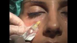 Relleno de Ojeras  Tratamiento Facial [upl. by Lennor]