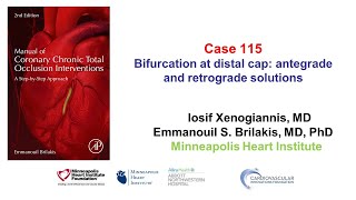 Case 115 Manual of CTO Interventions  Bifurcation at distal cap and retrograde crossing [upl. by Enylrac]