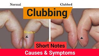 Finger Clubbing  Introduction Pathophysiology amp Causes  Mnemonic to remember causes of CLUBBING❤️ [upl. by Kram]