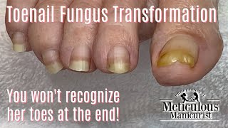 Pedicure How to Make a Toenail with Fungus Look Normal [upl. by Eirrehc]