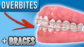 How Do BRACES FIX Overbites  Overbite Before and After Braces  Premier Orthodontics [upl. by Keyser]