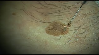 Skin Revision  Lesion Removal  Electrocautery  CLOSEUP  Here is how it works  Jade Clinics [upl. by Akeimahs]