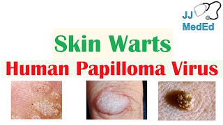 Overview of Skin Warts Verrucae  What Causes Them Who Gets Them  Subtypes and Treatment [upl. by Aciraj]