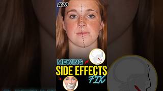 Mewing Side Effects Fix [upl. by Hassadah]