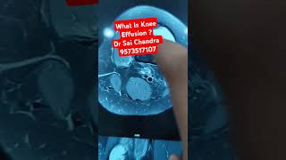 What Is Knee Effusion  Dr Sai Chandra 9573517107Joint Replacement Surgeon Hyderabad [upl. by Toffic]