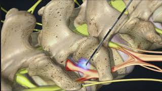 Transforaminal Root block injection [upl. by Eimak392]