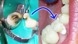 Full Root Canal amp Crown Procedure w Post amp BuildUp Placement Process Dental Treatment On A Molar [upl. by Hardunn]