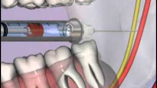 Medical Videos  Malameds Local Anesthesia  05 The Armamentariumaviflv [upl. by Junieta705]