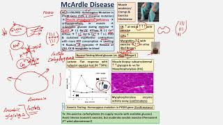 McArdle Disease CBL [upl. by Eyr]